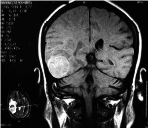 脑膜瘤手术后要注意怎样调养?