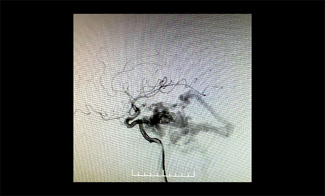 DSA检查显示,左侧天幕区硬脑膜动静脉瘘