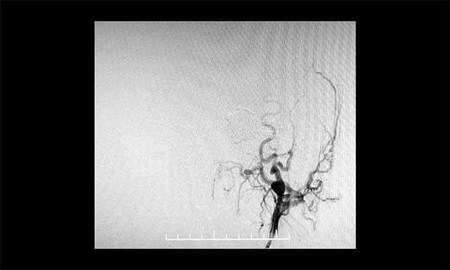 微导管造影确认后,注入 Onyx 18胶7.5ml