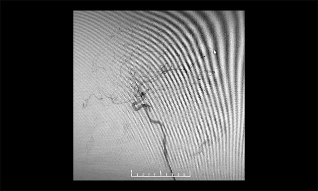 术毕左侧颈内动脉造影