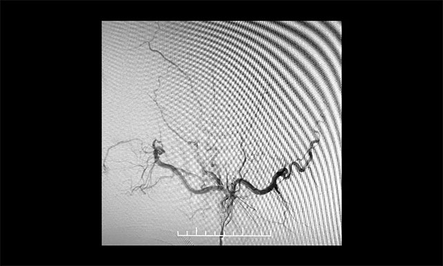 术毕左侧颈外动脉造影