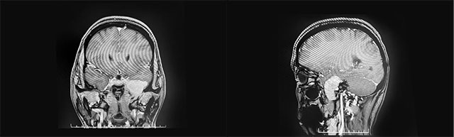 肿瘤位于左侧颅中窝颞叶内侧底部