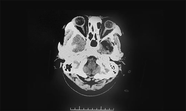 术后影像显示肿瘤被切除
