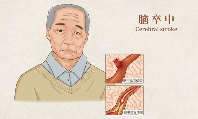 要正确认识颈动脉狭窄,及时治疗,降低脑卒中风险