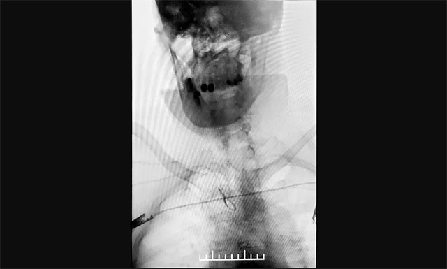 与传统经股动脉穿刺脑血管造影相比,经桡动脉穿刺造影相对复杂,但手术创伤小、穿刺点血肿发生率较低