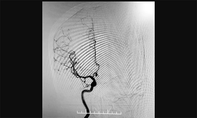 与传统经股动脉穿刺脑血管造影相比,经桡动脉穿刺造影相对复杂,但手术创伤小、穿刺点血肿发生率较低