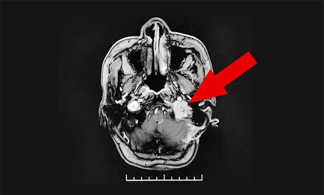 患者脑转移瘤病灶位置