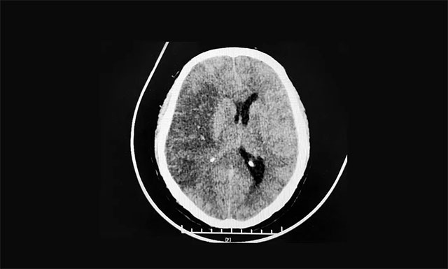 大面积出血性脑梗死