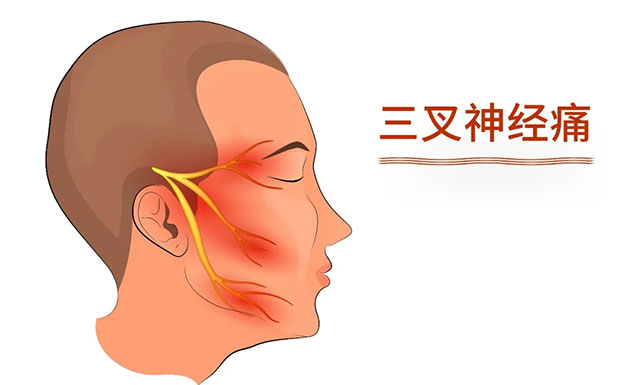 三叉神经痛有“天下第一痛”之称