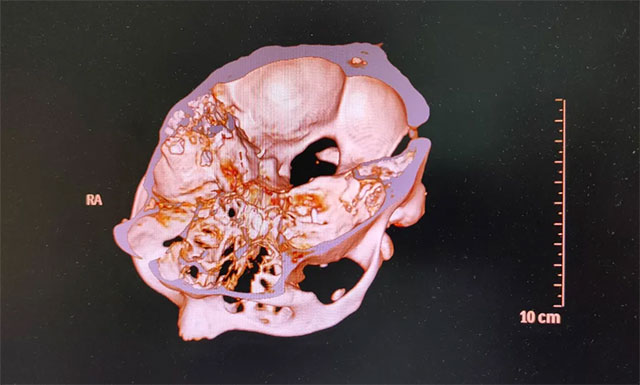 为患者开展多点射频热凝术治疗