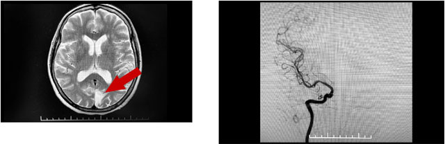 完善检查发现梗塞和动脉瘤