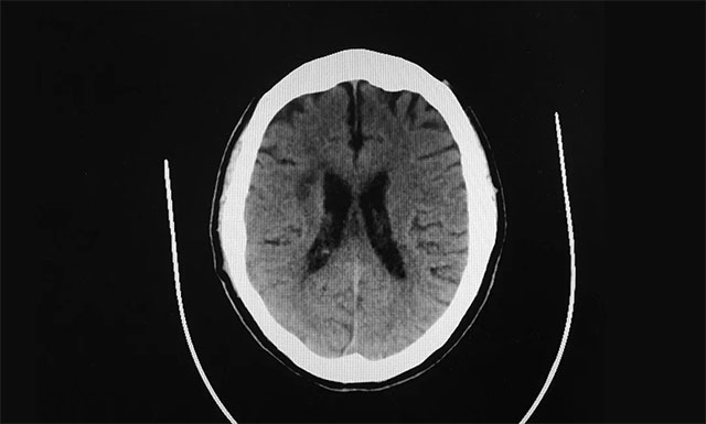 患者多发性脑梗,致使双下肢活动障碍