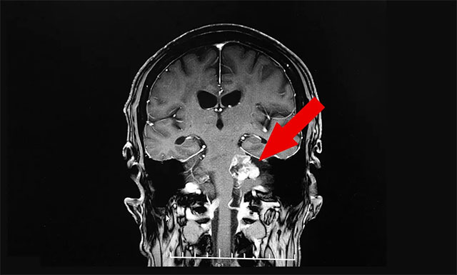 细心的周主任发现了患者的新病症——“听神经瘤”