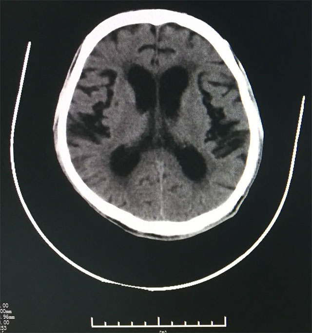 影像医学显示患者脑室增大