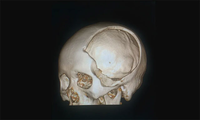 患者颅骨大面积缺损